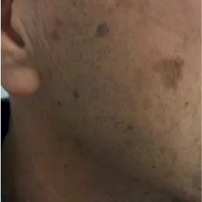 Before treatment