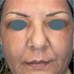 After treatment