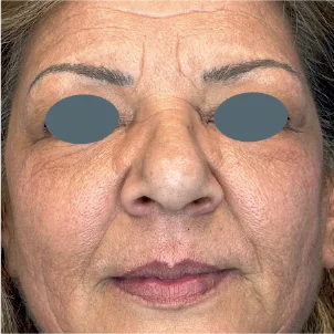 Before treatment