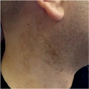 After treatment