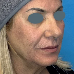After treatment