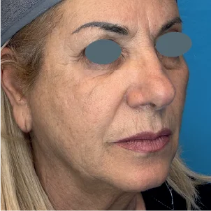 Before treatment