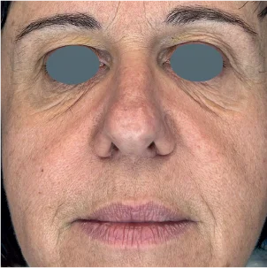Before treatment