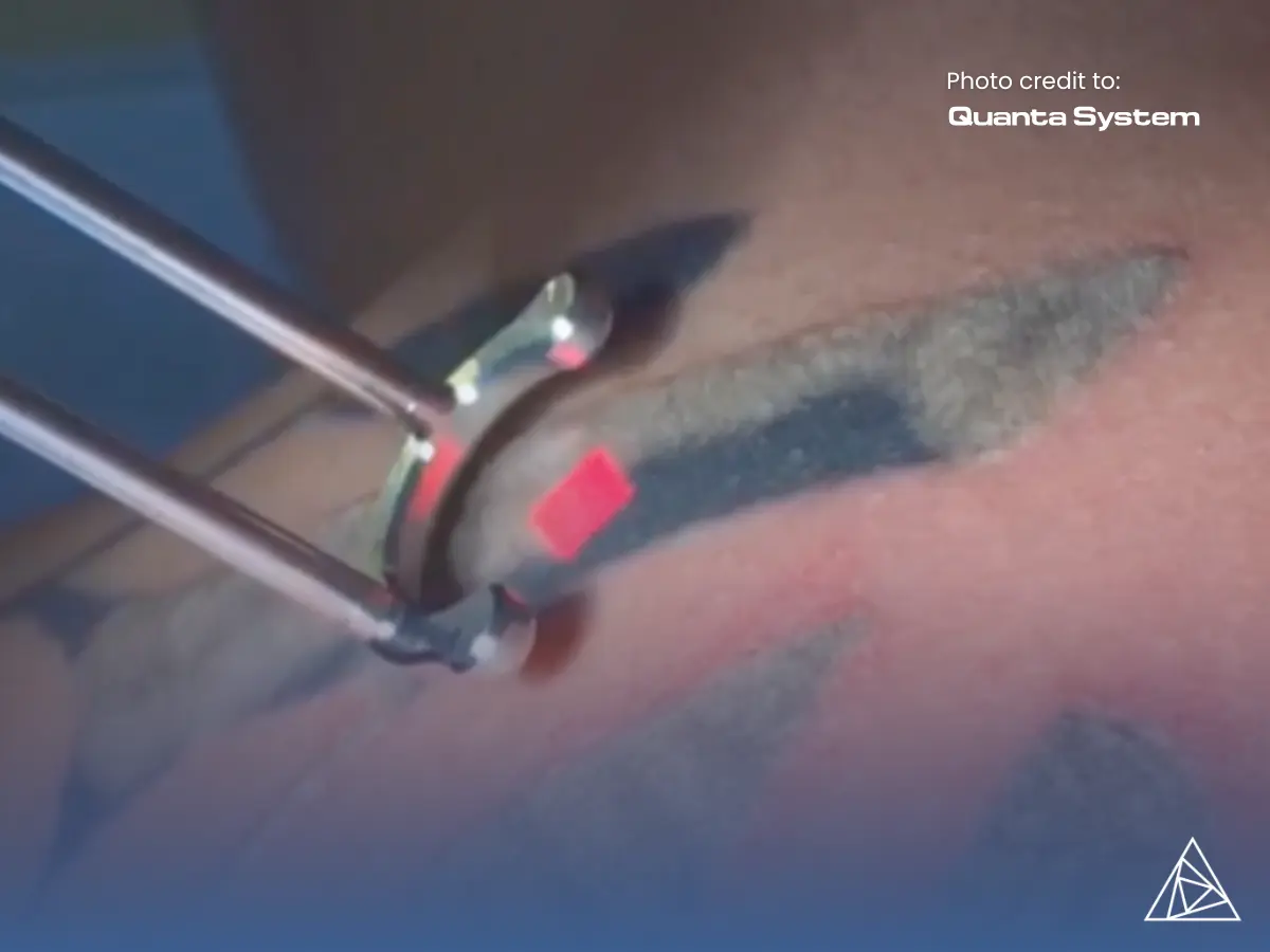 Why Medical Practices Trust the Q-Plus Series Tattoo Removal Device