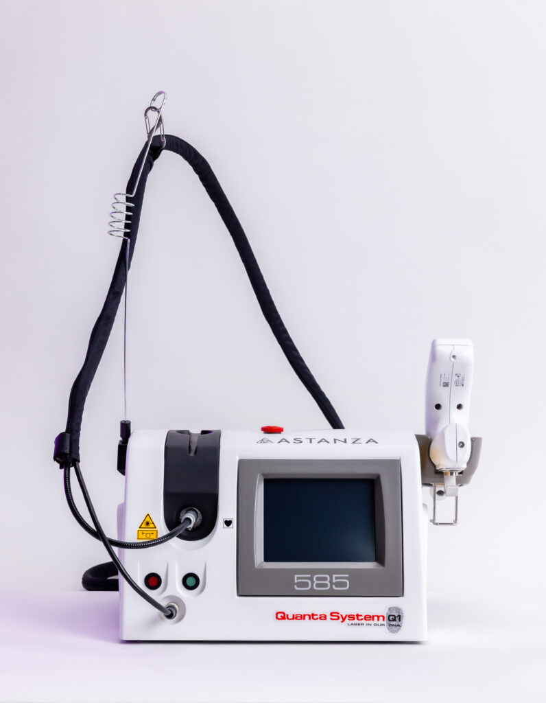 Quanta 585 laser for melasma and vascular treatments