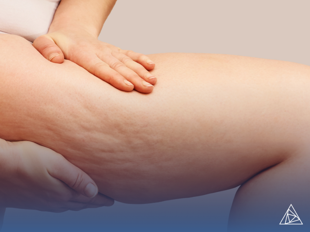 Cellulite Removal Technology: Understanding the Carbon Wave Patch in Modern Aesthetic Practice