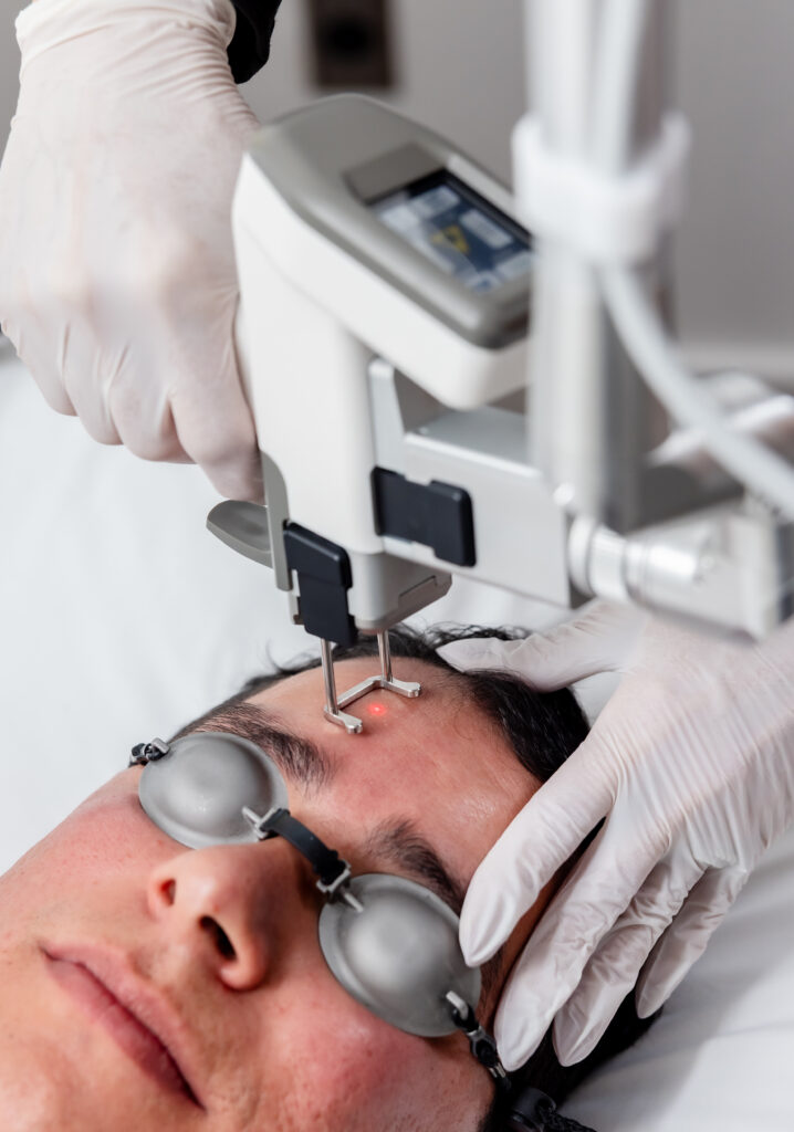 Youlaser acne treatment