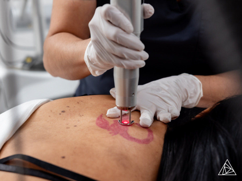 Treating Multicolor Tattoo Ink with Q-Switched Laser Technology