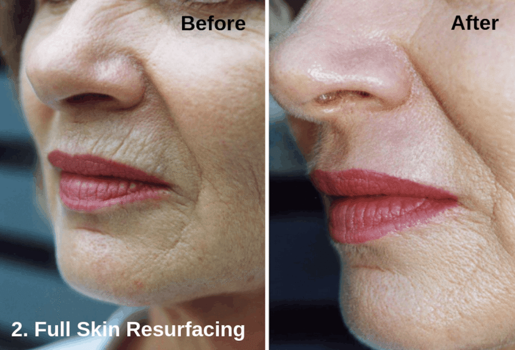 Full skin resurfacing treatment using Astanza DermaBlate laser technology