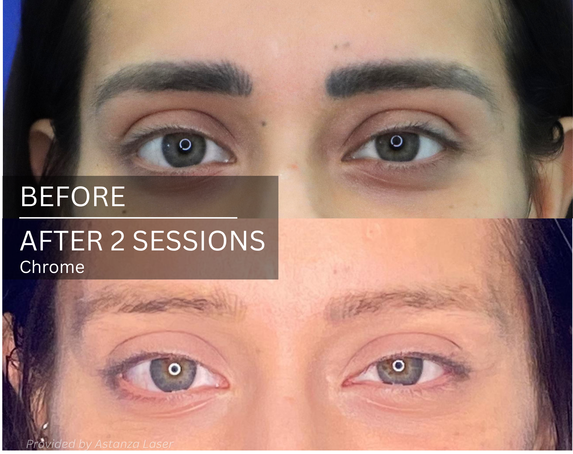 Astanza Laser Permanent Makeup Tattoo Removal