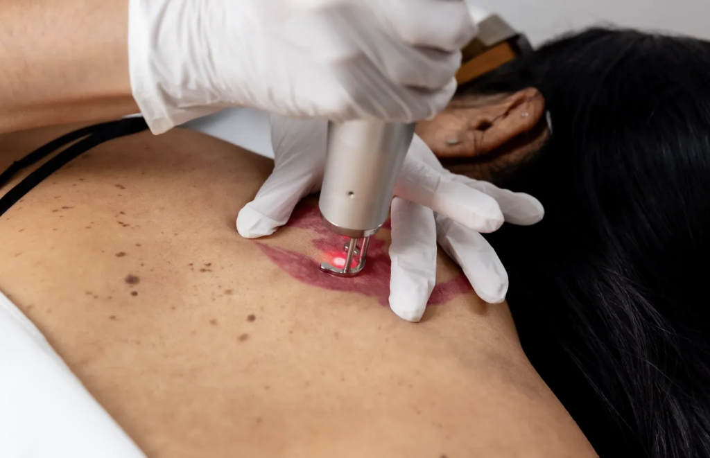 Laser Tattoo Removal Cost: How Device Power and Session Efficiency Drive Practice ROI